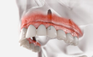 3D illustration of a maxillary fixed restoration with four dental implants, showing how implants support dental prosthetics for a secure and functional fit.