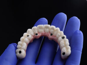 full arch dental implants with 6 holes for placement of the arch